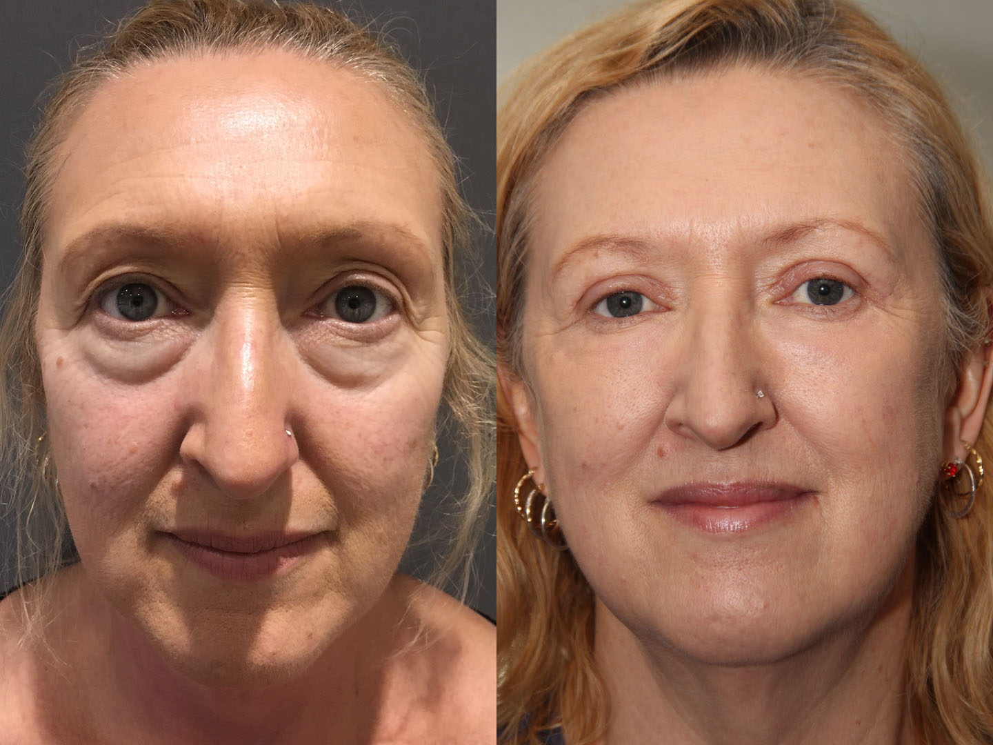 Before After 1
